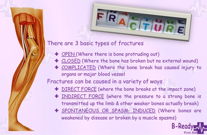 Types of fractures for First Aid reference