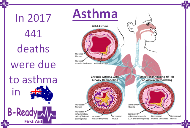  Asthma deaths in Australia & how Asthma affects the airways for First Aid understanding & management