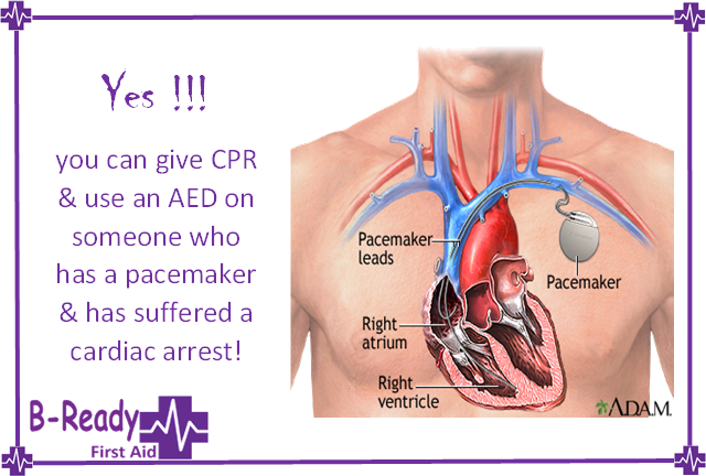 CPR on someone with a Pacemaker? YES!
