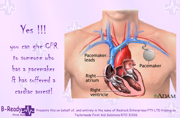 CPR on a casualty with a Pacemaker, YES! 
