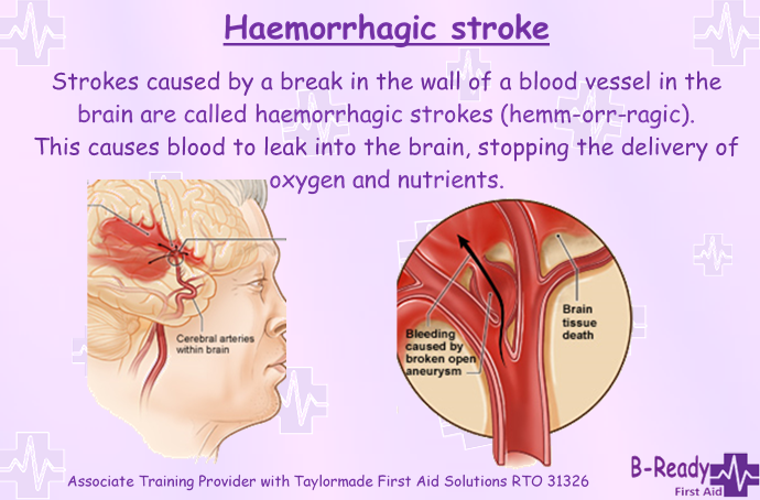 Haemorrhagic Stroke important for oxygen to the brain. CPR counts here.