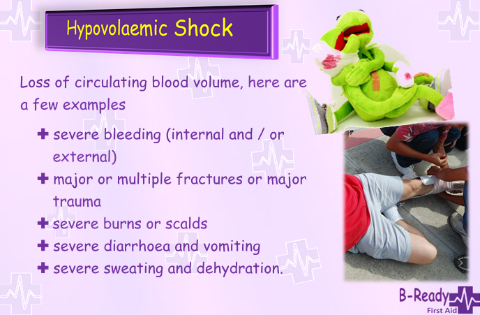 Hypovolaemic Shock signs and symptoms
