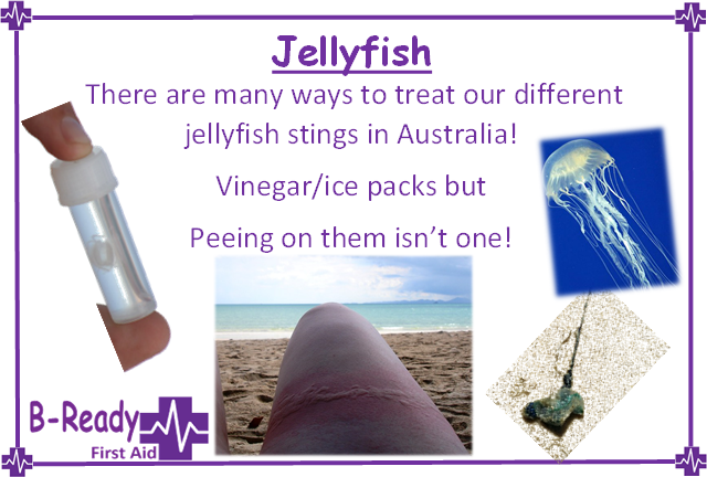 Peeing on any jellyfish sting in Australia is not the correct management by B-Ready First Aid